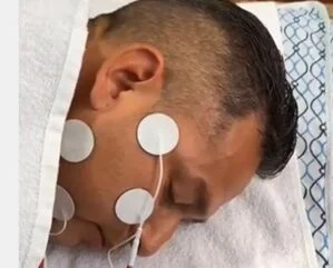 Fisioterapeutas rehabilitacion facial CDMX