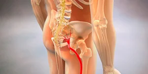 Tratamiento del Nervio Ciático -- blog de fisioterapia